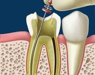 Endodoncia___PDC_58bf475e3bd8f